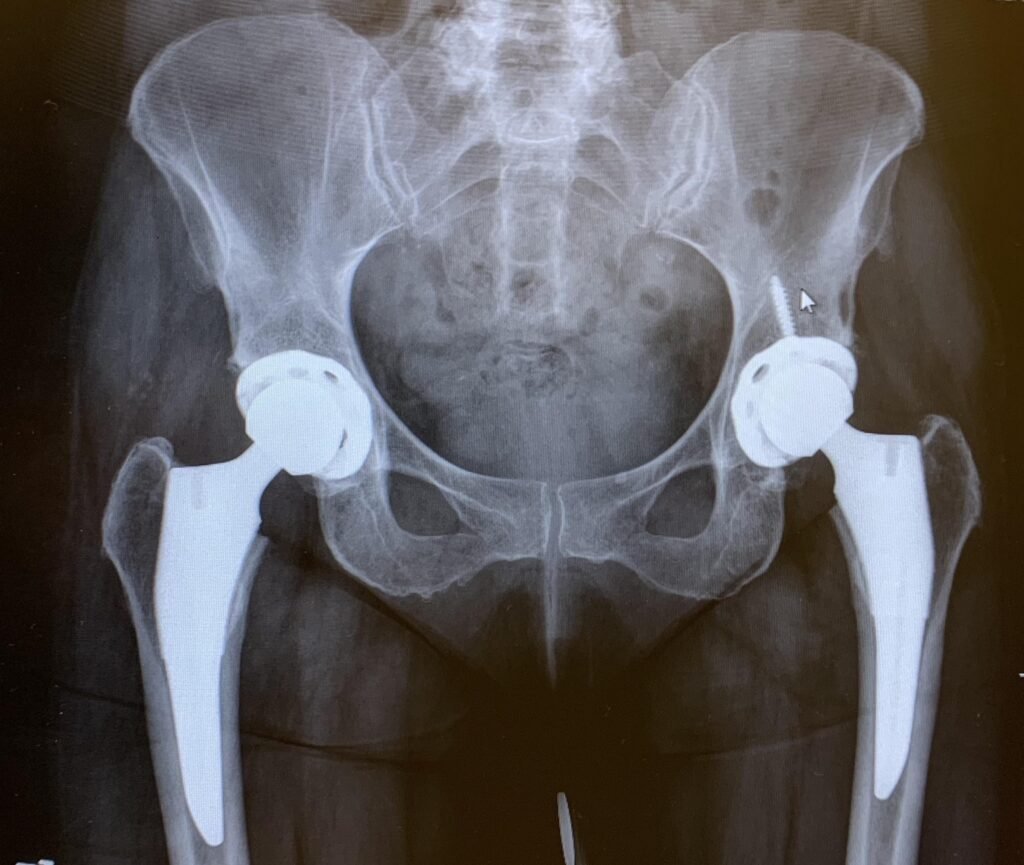 bilateral hip replacement melbourne