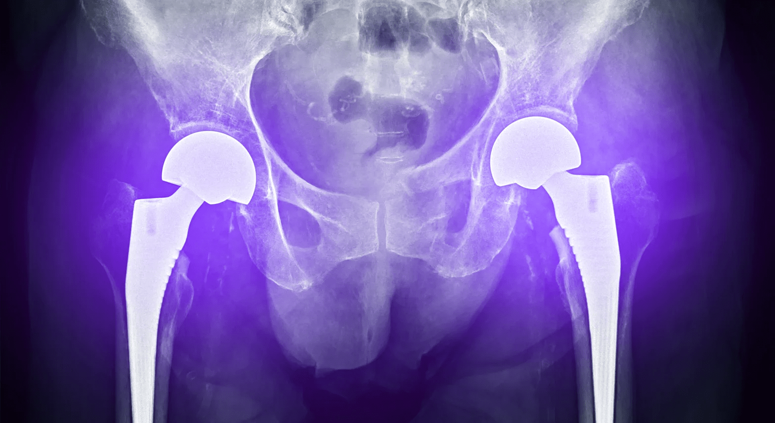 bilateral hip replacement xray melbourne