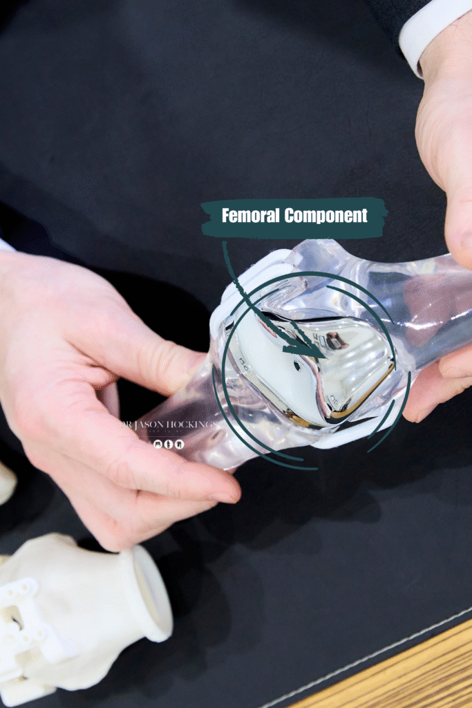 femoral component tka dr jason hockings (1)