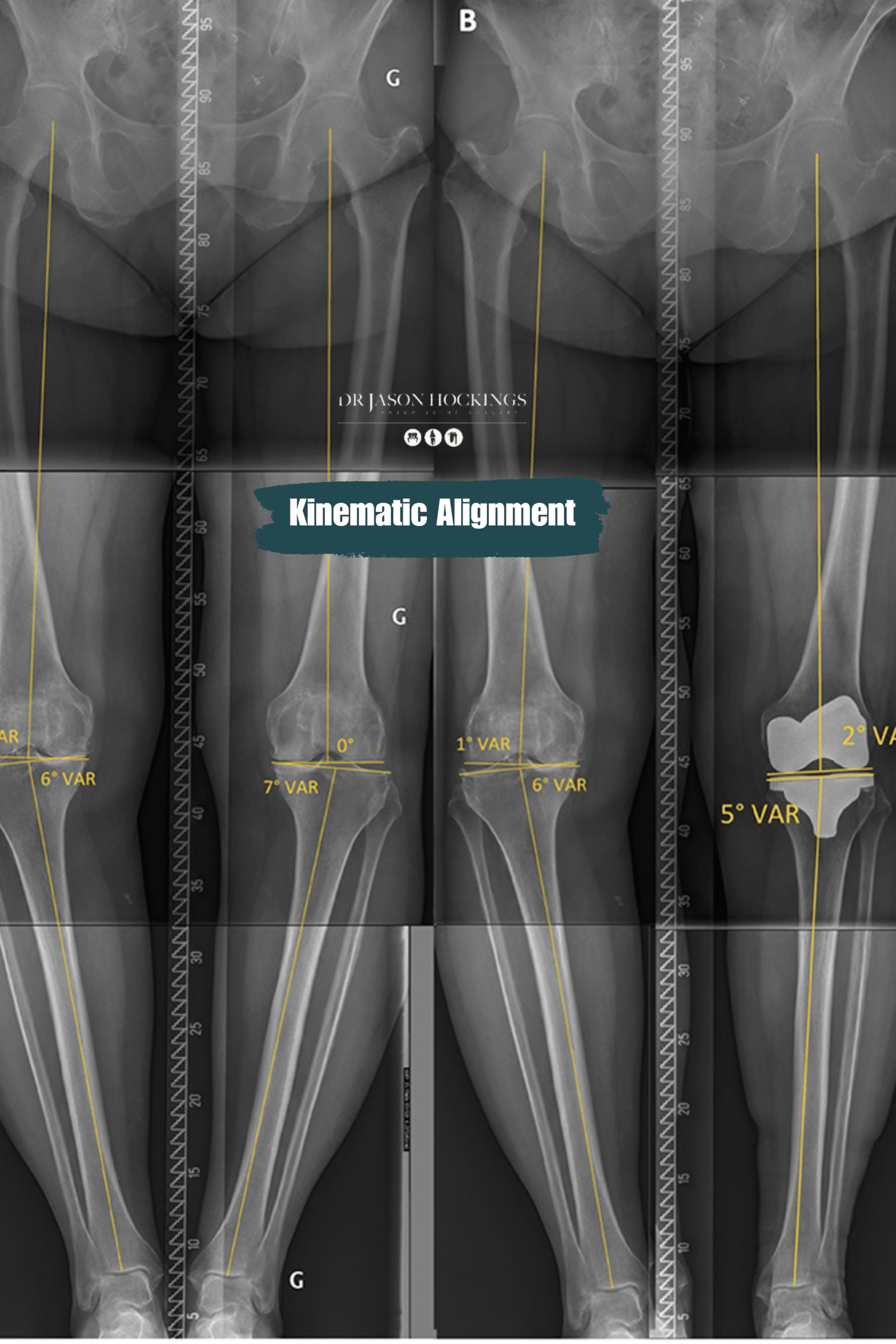 kinematic alignment dr jason hockings (1)