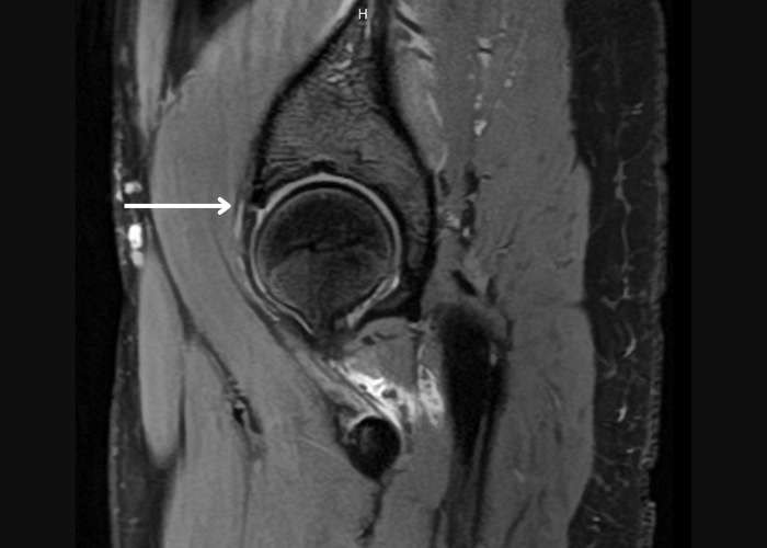mri of hip labrum tear