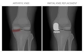 partial knee replacement x ray melbourne