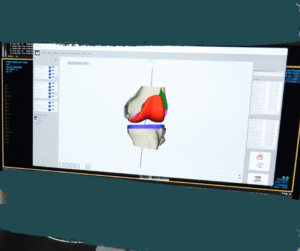 patient specific total knee replacement surgical plan