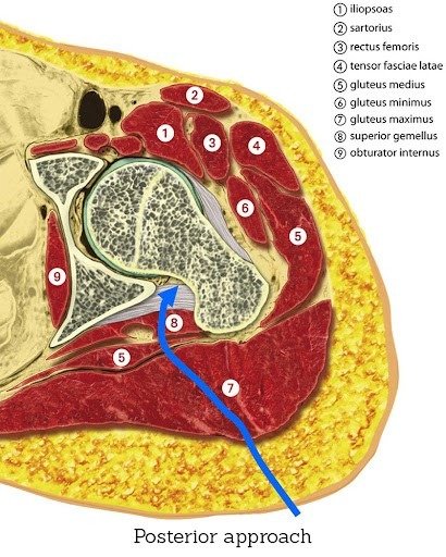 posterior approach thr drjason hockings