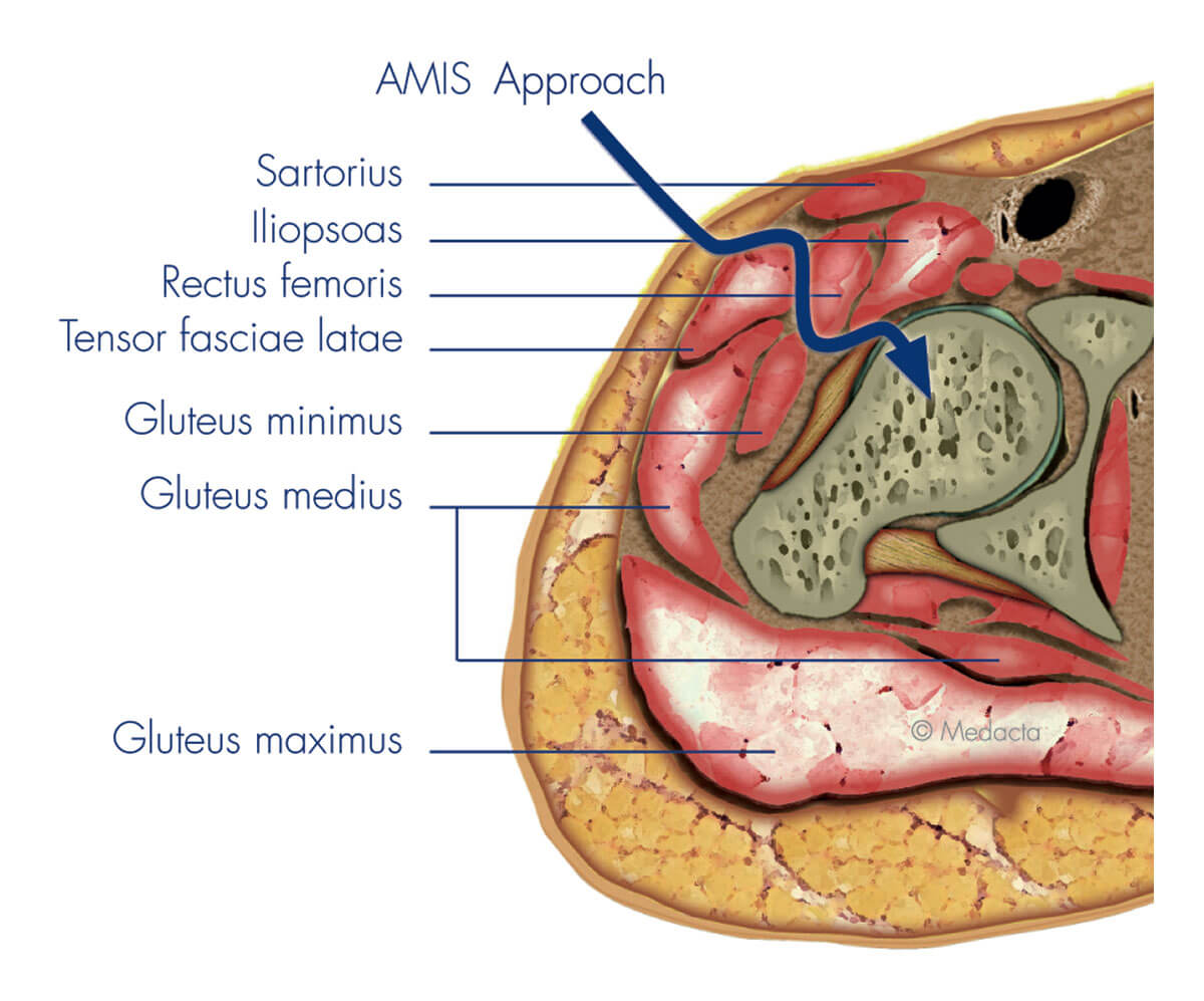 Anterior Approach Total Hip Replacement Surgery - Jason Hockings