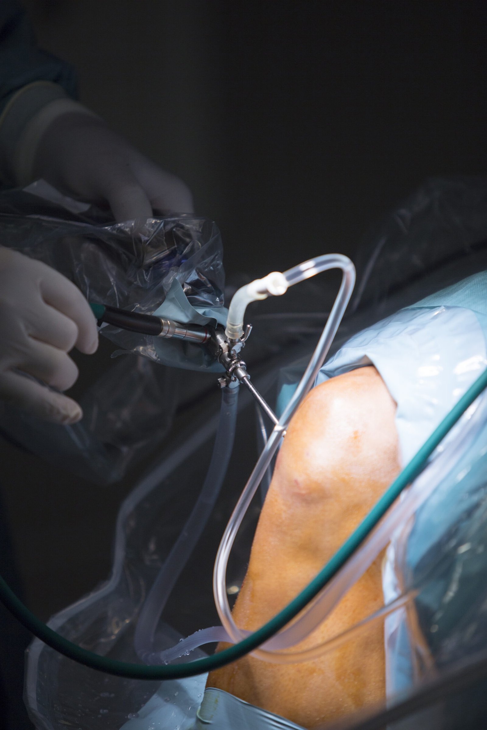 traumatology orthopedic surgery knee arthroscopy drip