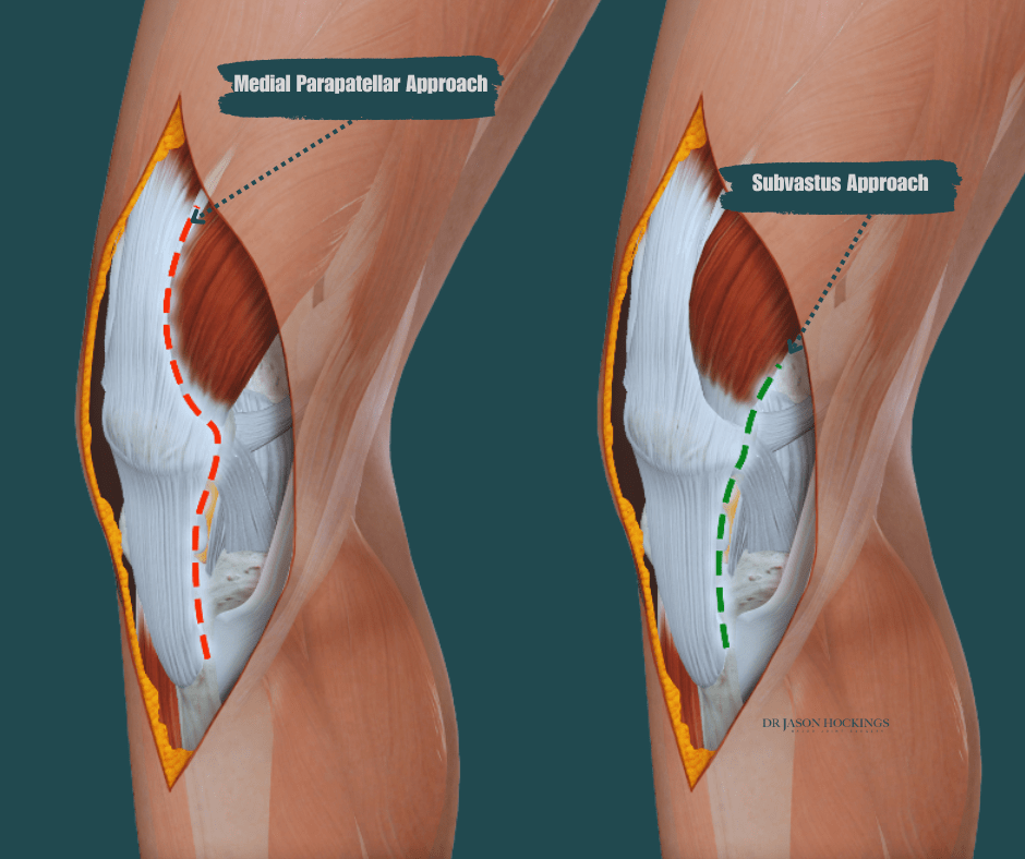 subvastus approach’ to total knee replacement
